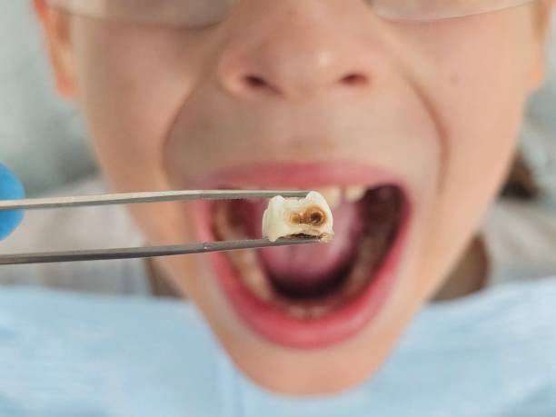Best Emergency Tooth Extraction in Sullivan Gardens, TN